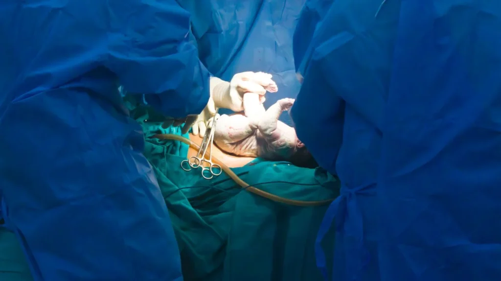 A group of people in blue scrubs assisting with a cesarean delivery.
