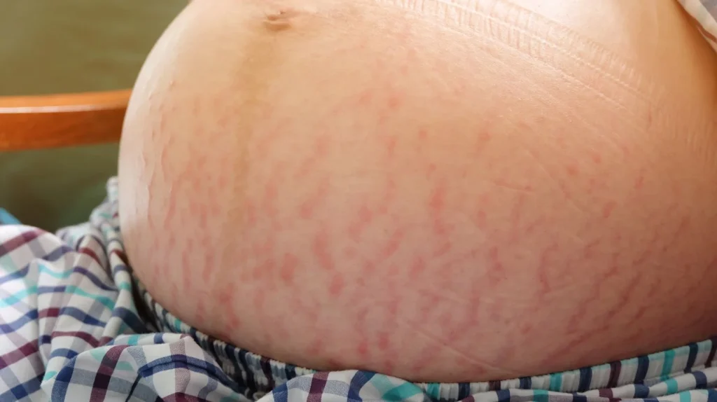 A pregnant woman's belly experiencing skin changes with red streaks.