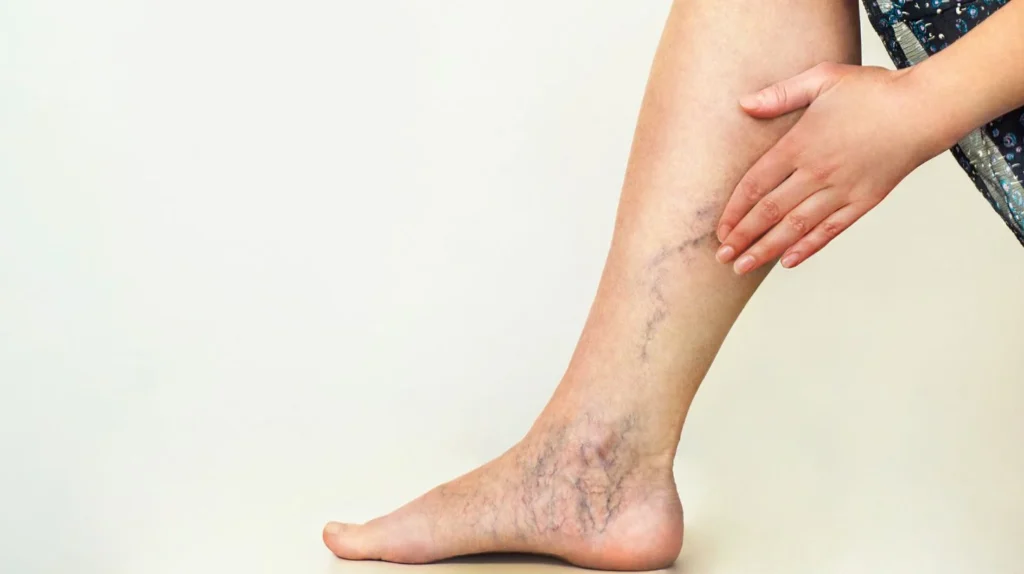 A woman's leg with varicose veins experiencing skin changes during pregnancy.